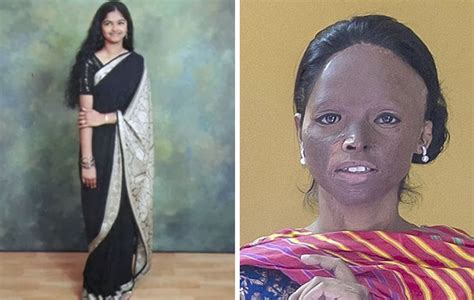 Acid Attack Survivor Becomes Face Of Fashion Brand In India Bored Panda