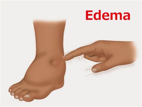 Some women experience water retention. Edema (Water Retention) - Symptoms, Home and Herbal ...