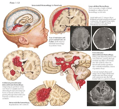 Intracranial Hemorrhage In The Newborn Pediagenosis