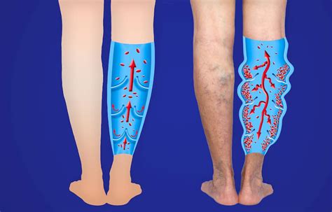 The Harley Street Heart And Vascular Centre Varicose Veins
