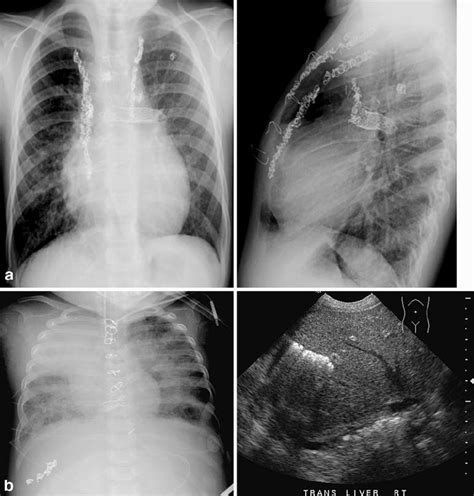 Coils Chest Radiographs Of A Child With Ebstein S Anomaly And