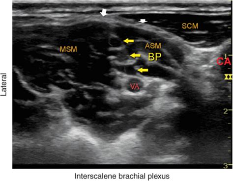 Ultrasound Guided Interscalene Brachial Plexus Block Hadzics