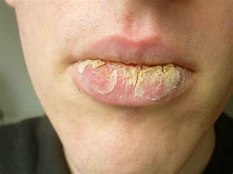 Exfoliative Cheilitis Pictures Causes Treatment And Diet