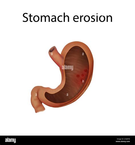 Erosion Of The Stomach Hi Res Stock Photography And Images Alamy