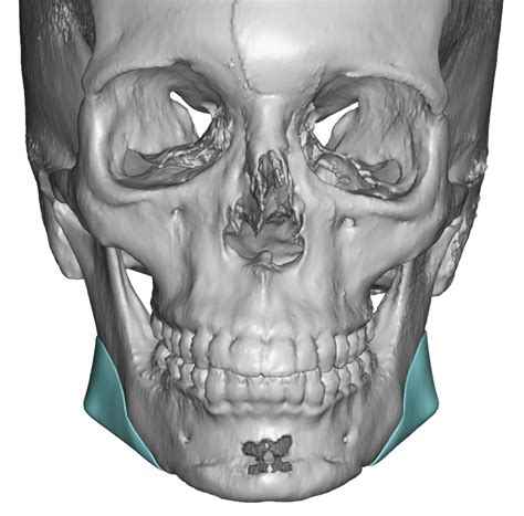 Female Custom Jaw Angle Implant Design Front View Dr Barry Eppley