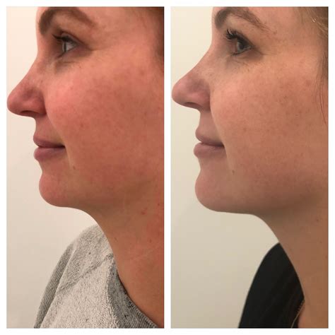 Kybella Before And After Somewhere Lately