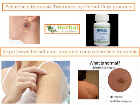 Treatment Of Seborrheic Keratosis Symptoms Herbal Care Products