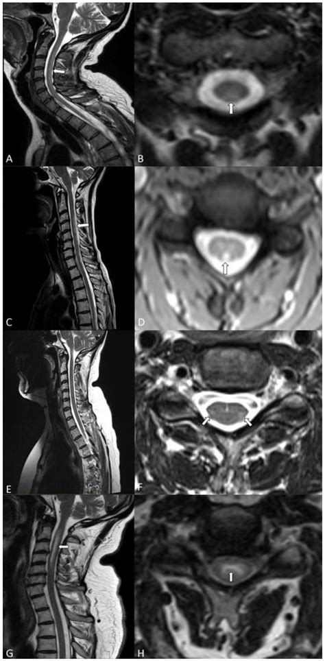 Cervical Spinal Cord Mri Of All Patients With Sagittal Left And Download Scientific Diagram