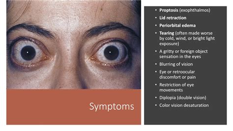 Let's start with related symptoms. Thyroid Eye Disease - YouTube