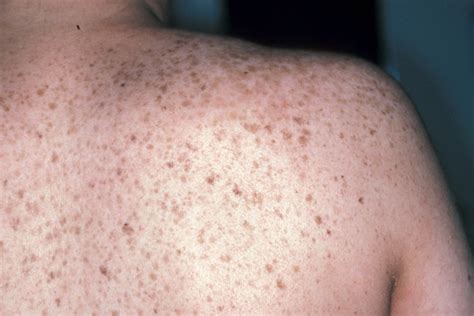 Brown Spots On Skin Pictures Causes Home Remedies Treatment