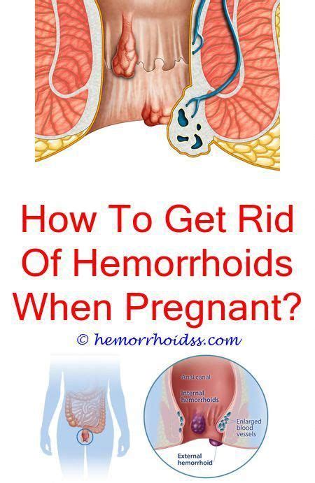 Hemorrhoids Are A Common Issue Specifically While Pregnant And As