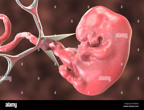 Aborto Ilustración Conceptual Instrumento Médico Cortar El Cordón