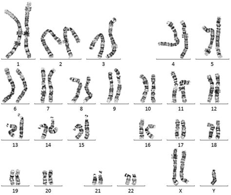 Karyotype Of Klinefelter Syndrome Vrogue Co