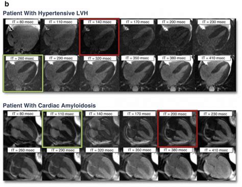 Multimodality Imaging Of Cardiac Amyloidosis Radiology Key