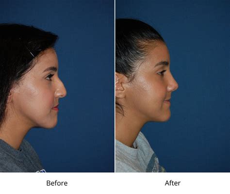 Rhinoplasty Surgeon Discuss The Dos And Donts After Surgery