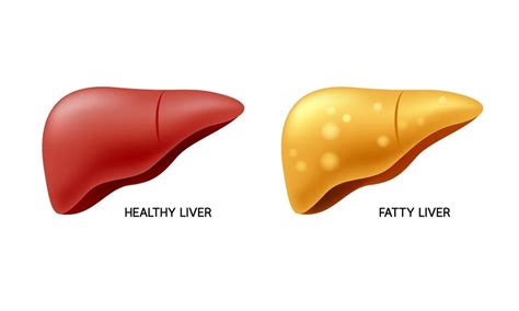 Does Fatty Liver Affect The Absorption Of Nutrients Fitpaa