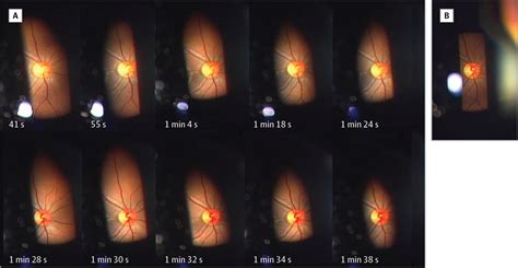 Fundus Video Of Retinal Migraine Neuro Ophthalmology Jama