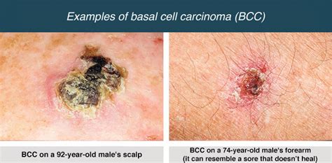 Skin Cancer Types Basal Cell Carcinoma BCC Squamous Cell Carcinoma