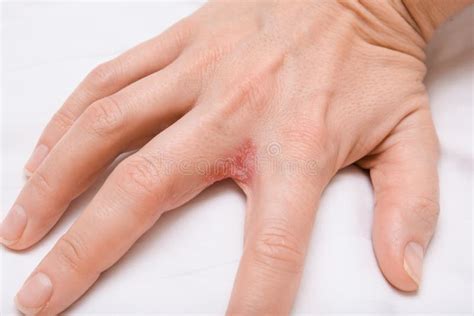 Eczéma Dyshidrotique Sur Le Pied Dermatite Blister Traité Avec