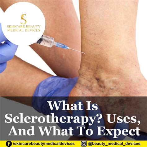What Is Sclerotherapy Uses And What To Expect