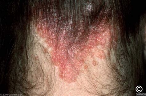 Minor Scalp Eczema