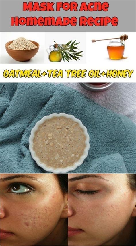 Learn How To Make A Homemade Mask For Acne Homemade Acne Mask