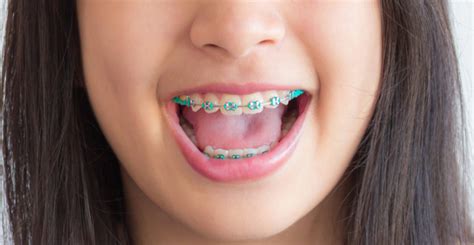 We did not find results for: LIFE WITH BRACES: FOODS TO AVOID | Unique Orthodontics