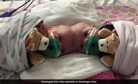 Doctors Just Separated Twin Girls Joined At The Head In One Of The