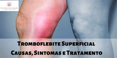 Tromboflebite Superficial Causas Sintomas E Tratamento