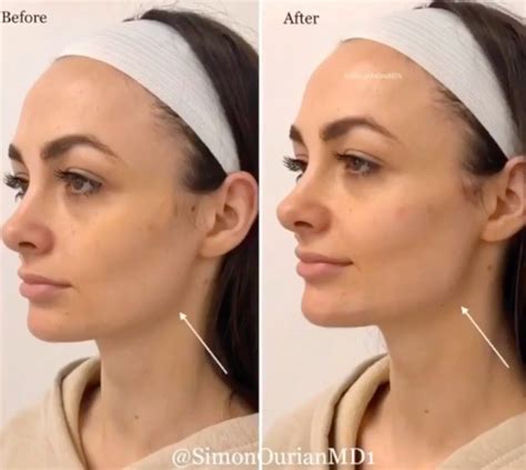 Simon Ourians Jawline Contouring Procedure Is Reshaping Beauty