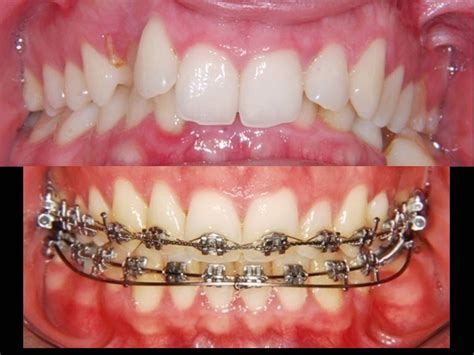 Amazing Deep Bite Correction Orthodontist Youtube