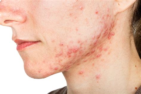 Expert Guide On Treating Jawline Acne Be Beautiful India