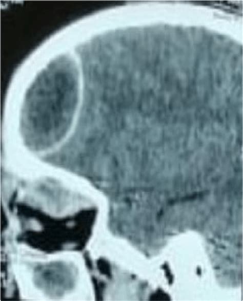 Ct Scan Imaging Showing Left Frontal Epidural Abscess With Enhancement