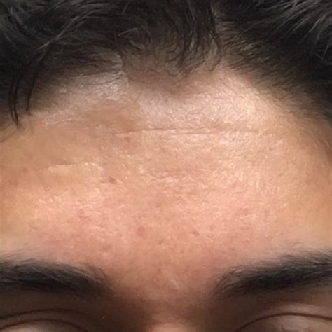 Treatment For My Forehead Scars Scar Treatments By Th3gentl3man