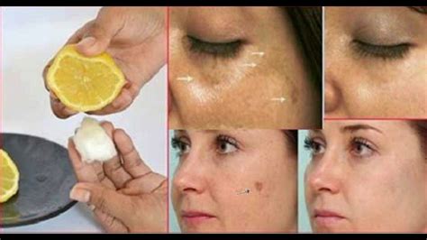 3 Best Trick To Remove Dark Spots And Scars From The Face Scar