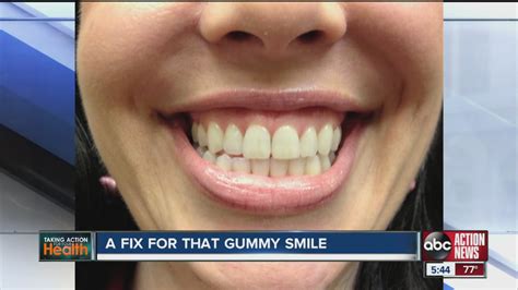 Botox Injections In The Upper Lip Area Fixes Gummy Smiles Youtube