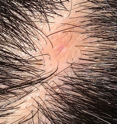 Localized Hair Loss On The Scalp — Donovan Hair Clinic