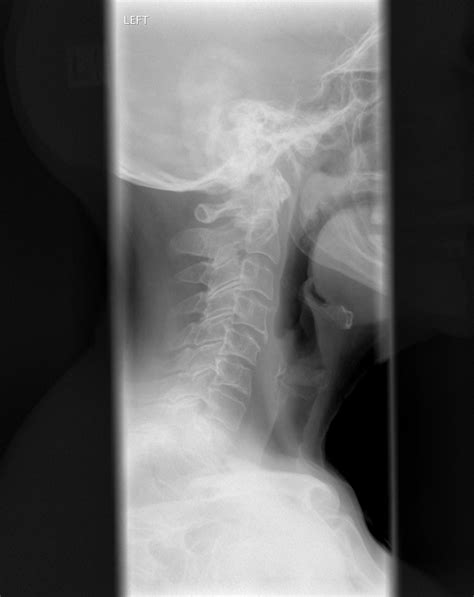 Filecervical Spine Xray