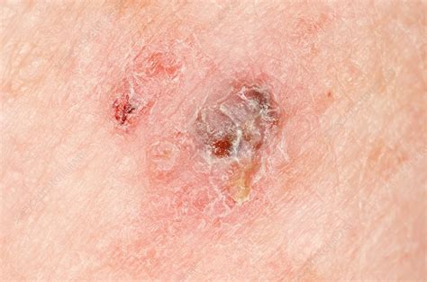 Pictures Of Skin Cancer Skin Cancer Spots