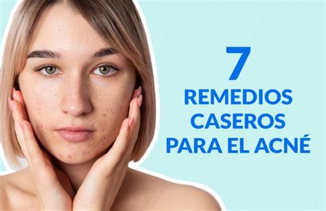 Arriba 101 Imagen Recetas De Remedios Caseros Para El Acne Abzlocalmx