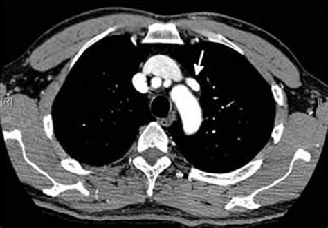 What Is A Ct Scan With Contrast For Chest