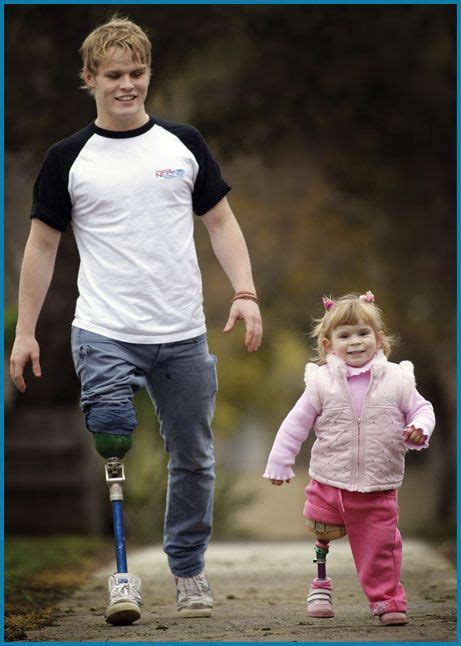 Supporting Amputees Limbs 4 Life This Girl Is About The Age I