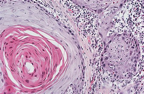 Squamous Cell Carcinoma Images Femalecelebrity