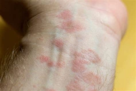 Pink Spots On Skin Causes And Treatments Skin Care Geeks