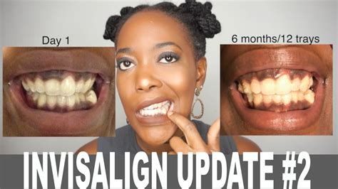 6 Month Invisalign Update With Pictures Youtube