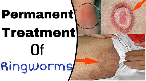 How To Get Rid Of Ringworm Scars Does Turmeric Really Cure Ringworm