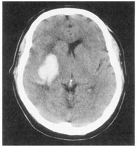 Intracerebral Hemorrhage General Evaluation And Treatment Neupsy Key