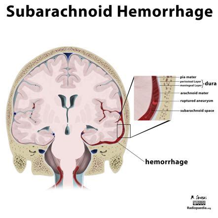 Subarachnoid Hemorrhage Summary Radiology Reference Article