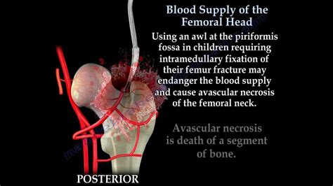 Avascular Necrosis Blood Supply Femoral Head Everything You Need To