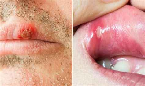 Causes Of Canker Sores And How To Treatment Them